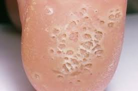 Image result for verrucae filiformes