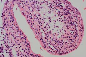 Image result for Chorioamnionitis