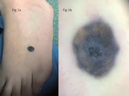 Image result for Blue Nevus