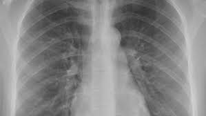 Image result for lung cancer xray