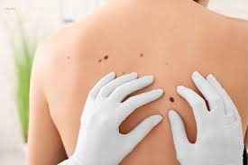 Sunburns can range from mild to blistering. 4 Ways You Can Get Skin Cancer Besides Sunlight Dr Hung