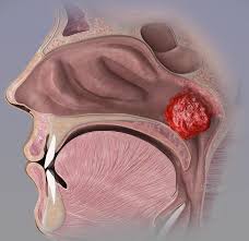 Adenoidectomy