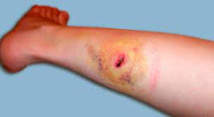 Septic shock occurs when your blood pressure drops rapidly and dangerously low. Blutvergiftung Sepsis