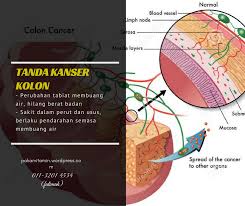 Check spelling or type a new query. Fahami Kanser Kolon Dan Tanda Tandanya Pengedar Shaklee Malaysia