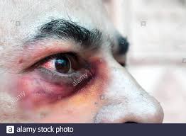 Konjunktivitis Augen Stockfotos Und Bilder Kaufen Alamy