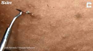 Folliculitis is when there are recurrent cases of infected ingrown hair. Grim Video Shows Pus Stream Out Of Woman S Bikini Line As Ingrown Hairs Are Pulled Out