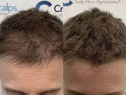 La county assistant chief coroner ed winter, says that reports that jackson was almost bald, emaciated and that his hips, thighs, and shoulders were riddled with needle wounds are simply not accurate. Scalp Micropigmentation Uk Hair Tattoo South East Creative Scalps