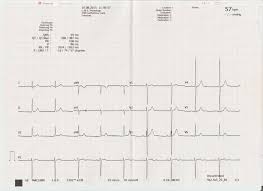 Voltage criteria (slc), and ua subgroup (nua or pua). I Have Lvh Should I Be Worried Normal Variants Of An Ecg The Student Physiologist