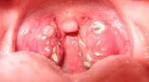 Image result for Peritonsillar Abscess