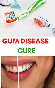 Gum Disease Cure How Cure Periodontal Disease Gum Disease Gum Infection Gingivitis Treatment Natural Remedies Kindle Edition By Brown Stacey Health Fitness Dieting Kindle Ebooks Amazon Com
