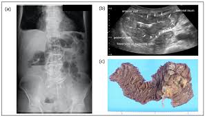 Image result for Constipation in Cancer