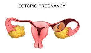 Keputihan/lendir putih yang banyak dari kebiasaan. Ini Celoteh Ku Kehamilan Luar Rahim Ectopic Pregnancy
