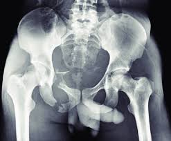 Superior and inferior superior (from latin super 'above') describes what is above something 21 and inferior (from latin inferus 'below') describes what is below it. Pelvic X Ray Showing Fractures Of The Right Superior And Inferior Rami Download Scientific Diagram