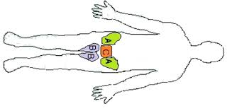 The treatment of groin hernia can be divided into five eras. Schematic Representation Of Subregions Of Groin Symptoms A Inguinal Download Scientific Diagram