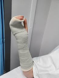 Image result for Radial Gutter Cast