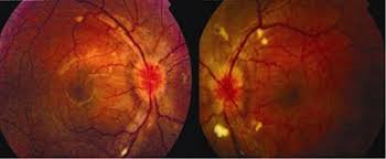 Acute angle closure glaucoma completely blocks your canals. Acute Angle Closure Glaucoma As The Presenting Sign Of Hypertensive Crisis Eye