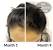 Female Hair Loss At Sides Of Head