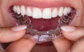 Braces straighten teeth in about 2 years. Straighten Your Teeth With Invisible Braces Smile Team Orthodontics Blogsmile Team Orthodontics Blog
