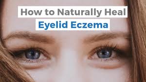 I want to get rid of them as quick as i can because makeup covers the redness, but they still stick. How To Naturally Heal Eyelid Eczema It S An Itchy Little World