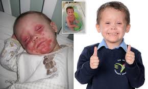 Morgan Bishop who begged to die because of eczema has 'life-changing  treatment'