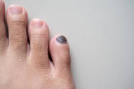 Image result for toe black diabetes