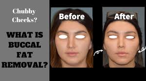Hypertrophied masseter muscles become more evident after fat removal of the pad. Buccal Fat Removal 3999 Cheek Reduction Surgery Beverly Hills