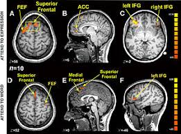 Stwardnienie rozsiane (w skrócie, wywodzącym się od angielskiej nazwy multiple sclerosis, określane jako sm lub ms) to choroba o podłożu. Funkcjonalne Obrazowanie Metoda Rezonansu Magnetycznego Wikipedia Wolna Encyklopedia
