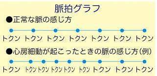 不整脈の種類をセルフ診断 心房細動や期外収縮の脈拍がわかるグラフつき カラダネ 2021 不整脈 心房細動 学習ノート