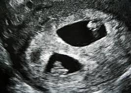 Eineiige Oder Zweieiige Zwillinge Babywelten Ch
