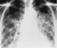 drug lung  DİSEASE ile ilgili görsel sonucu