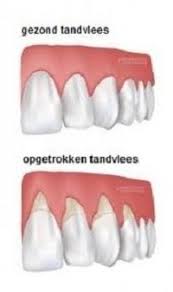 Lees grootmoeders tips op oma weet raad. Top 15 Huismiddeltjes Tegen Terugtrekkend Tandvlees Dental365 Nl