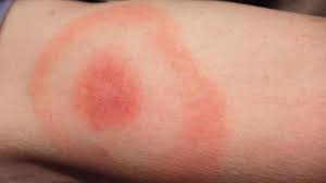 Maybe you would like to learn more about one of these? Maladie De Lyme Deux Chablaisiennes Racontent Leur Combat Le Messager