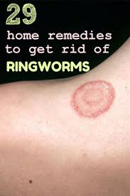 Homeremedyhacks Get Rid Of Ringworm Home Remedies For Ringworm Home Health Remedies