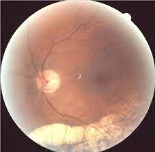 Scar Following Old Retinal Detachment Eye Health Optometry Eye Care