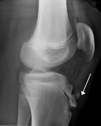 Osgood Schlatter Disease Wikipedia