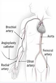 Learn vocabulary, terms and more with flashcards, games and other study tools. Reaching The Heart Through An Artery In The Wrist Harvard Health