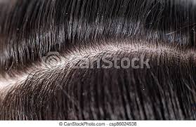 Dandruff in hair causes severe itching. Scales Of Dandruff In A Man S Black Hair The Concept Of Getting Rid Of Dandruff And Hair Care Background Macro Scales Of Canstock