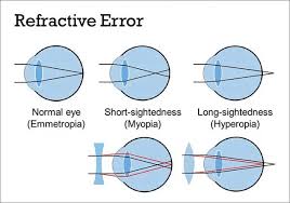 Image result for Refractive Error
