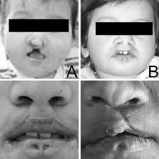 Affected members of family 2 with various clinical associations of lip...