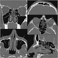 Plos Neglected Tropical Diseases Facial Structure Alterations And Abnormalities Of The Paranasal Sinuses On Multidetector Computed Tomography Scans Of Patients With Treated Mucosal Leishmaniasis
