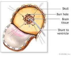 Pin On Psevdotumor