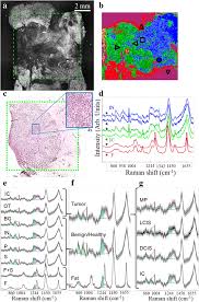 The goal of cancer surgery is usually to get clean margins. Intra Operative Spectroscopic Assessment Of Surgical Margins During Breast Conserving Surgery Breast Cancer Research Full Text