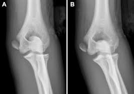 To compare surgical outcomes from medial epicondyle fracture fixation with absorbable cartilage nails to those from traditional kirschner wire fixation. Nonoperative Medial Epicondyle Humeral Fracture Care Slightly Better Than Surgery