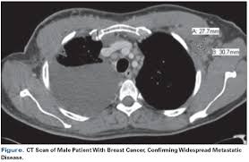 Breast and thyroid tissue tend to be more sensitive to radiation. Palb2 Positive Breast Cancer In A 40 Year Old Man