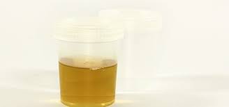 Onverklaarbaar Donkere Urine Personal Weightloss
