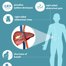 Liver Cancer Signs Symptoms And Complications