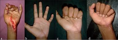 Used as hand exercise to reduce adhesions between fds and fdp. Clinical Photographs Of Same Patient With Left Side Showing A Cut Download Scientific Diagram
