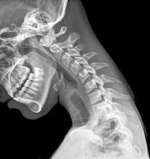 Teens Compulsive Texting Can Cause Neck Injury Experts Warn Xray Art Human Body Anatomy Art