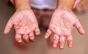 Image result for Hand foot and mouth disease HFMD roof of mouth