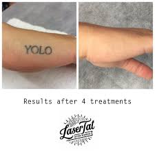 At cascade's laser tattoo removal center, we researched the latest technological lasers in great our goal is to remove your tattoo in the fewest treatments possible. Lasertat Tattoo Removal Adelaide